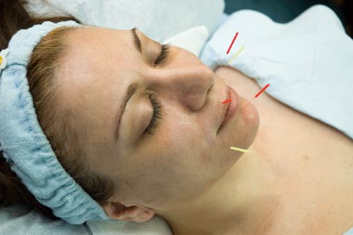 facial_acupuncture